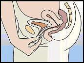 Nuvaring sistema de liberacion vaginal-figura5